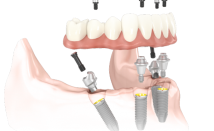 Implant en Titan