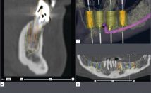 Planification 3D. IAO (Implantologie assistée par ordinateur)