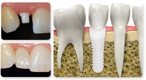 Zirconia Implant