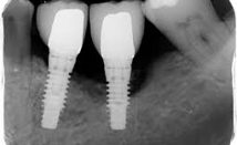 Traitement péri implantite