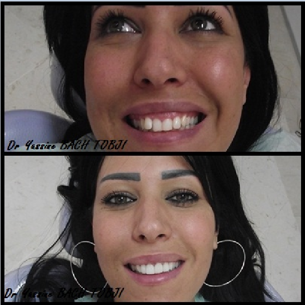 Facettes Céramiques